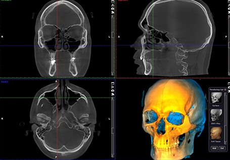 Crâne entier 300 μm